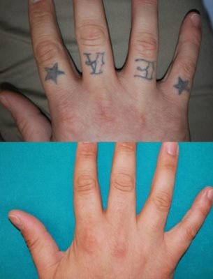 Salute / Un tatuaggio non è per sempre: le dieci cose da sapere prima di rimuovere un tattoo