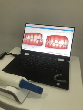 Impronta dentale digitale