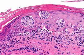melanoma microscopio