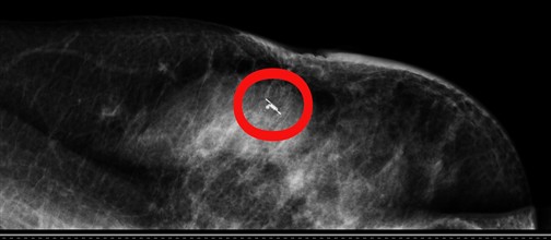 Ospedale Cannizzaro / Un “radar” per individuare lesioni tumorali impalpabili